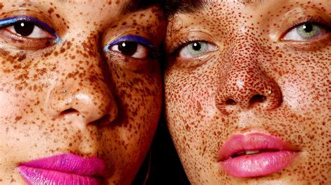 Understanding The Beauty Of Freckles Types Causes And Treatments