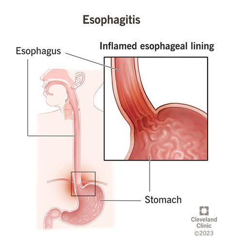 esophagitis    symptoms  treatment