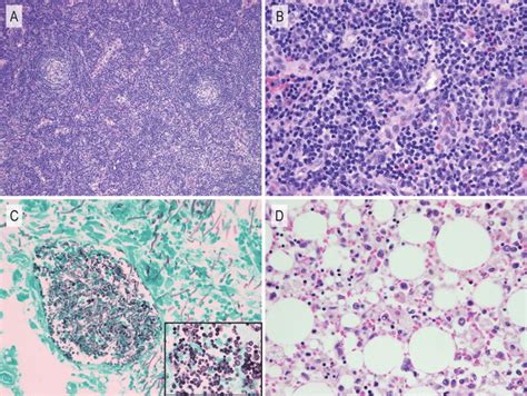 Pathological Findings Of The Present Case Cervical Lymph Node Biopsy