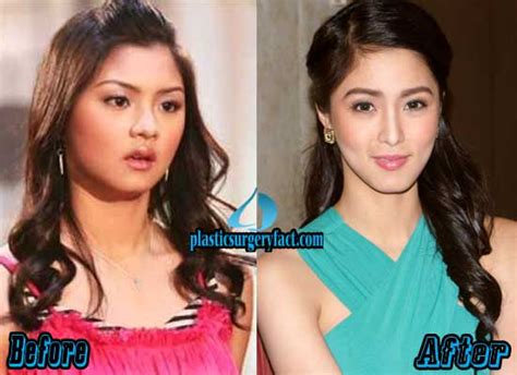 kim chiu plastic surgery before and after photos plastic surgery facts