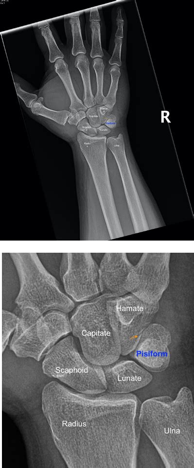 avulsion fracture  styloid process  ulna