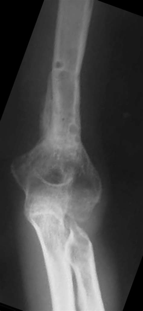 infected nonunion elbow case  dr mark brinker houston orthopedic