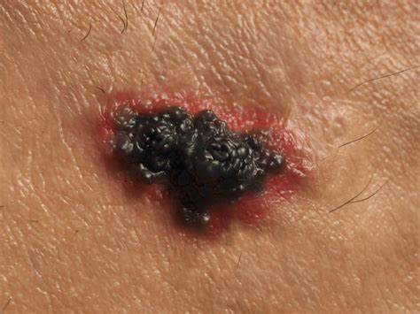 Melanoma Stages Types Causes And Pictures