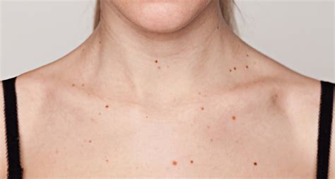 Number Of Skin Moles Tied To Breast Cancer Risk Science News