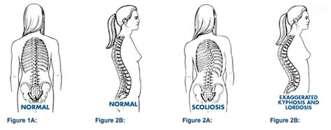 Medical Management Of Scoliosis Part 2 Of Our Series On Curvature Of