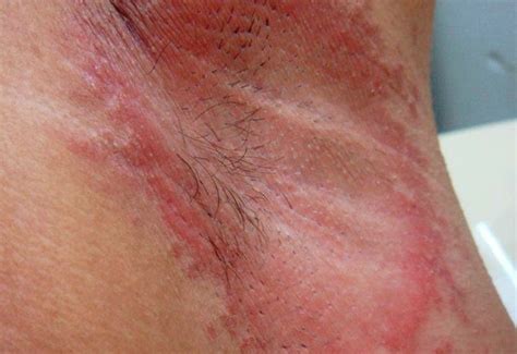 underarm rash pictures treatment symptoms causes