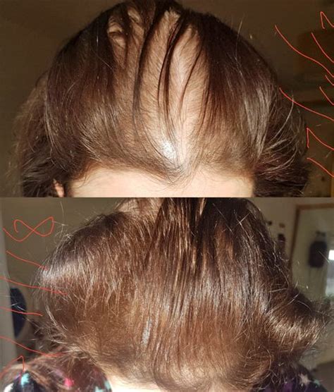 How Rogaine Regrew This Woman S Thinning Hair In 6 Weeks Rogaine