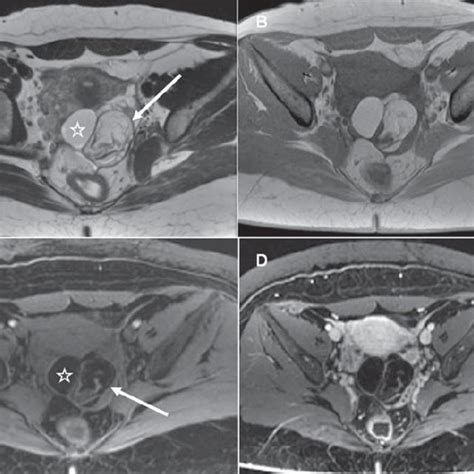 ovarian torsion caused   mature teratoma pelvic mri  left ovary  scientific