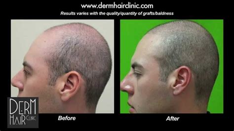 fue hair restoration cost reduction buzz cut  fue hair transplant