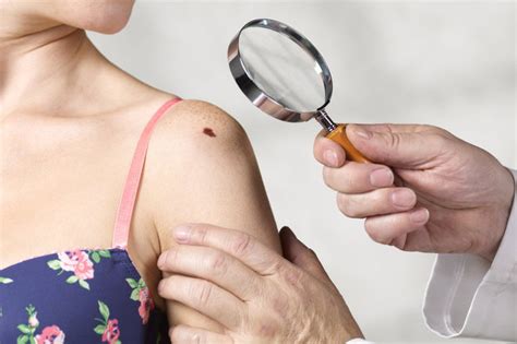 10 Signs Your Mole Might Be Cancerous Daily Star