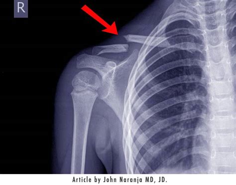 dr john esq clavicle fractures  birth diller law personal injury law