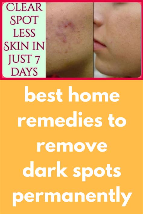 best home remedies to remove dark spots permanently today i will share