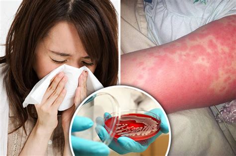 Scarlet Fever Symptoms Seven Signs You Should Never