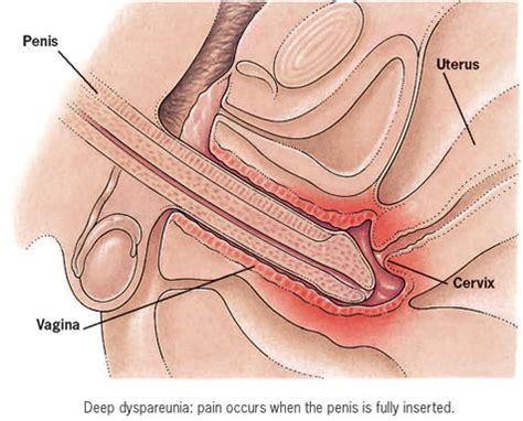 Bent penis during sex
