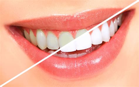 teeth whitening   lanas dental care