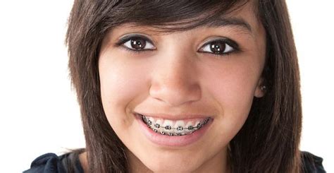 types of braces concord ca lee orthodontics