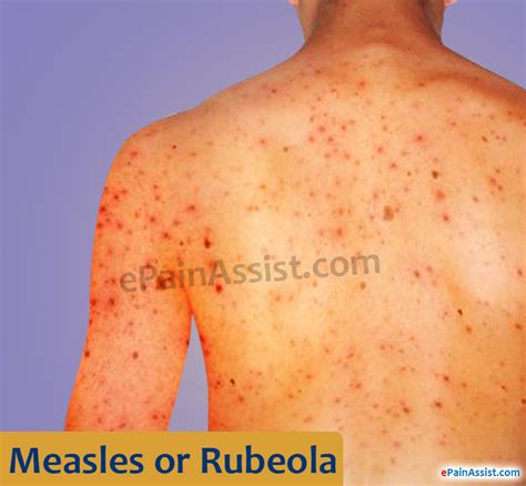 measles or rubeola causes risk factors symptoms stages