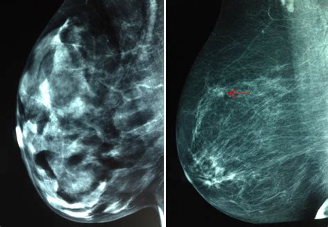 Laws Tell Mammogram Clinics To Address Breast Density The New York Times