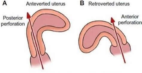 What Is Tilted Or Retroverted Uterus And Ultrasound