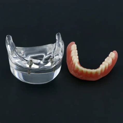 dental implant teeth model mandibular overdenture restoration  inferior jaw  picclick
