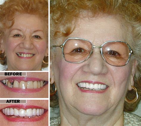 dental implants  dentures brooklyn implant dentist