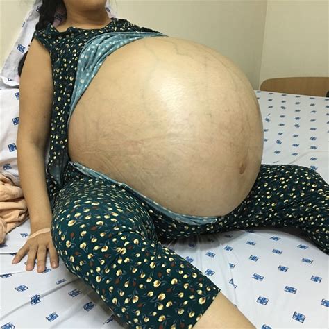 Doctors In Hcm City Remove Massive Ovarian Cyst Society