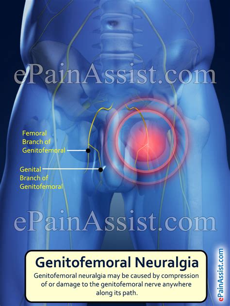 Genitofemoral Neuralgia Treatment Causes Symptoms Types