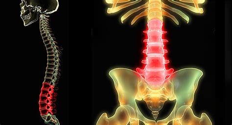 Low Back Pain Pictures Symptoms Causes Treatments