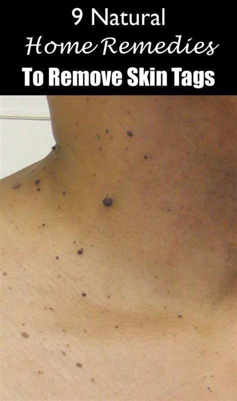 how to remove skin tags health pinterest skin tag