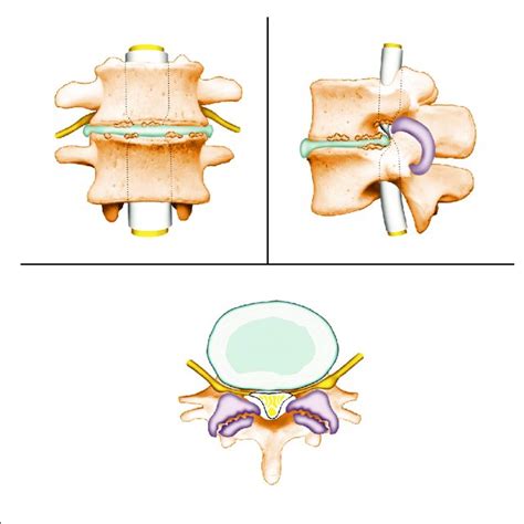 Pdf Variation In The Care Of Surgical Conditions Spinal Stenosis