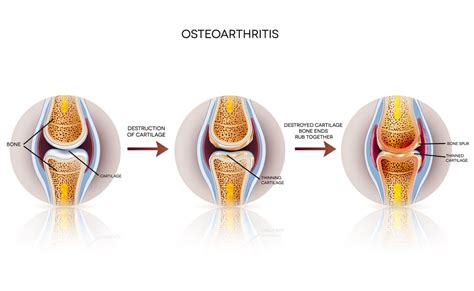 pain osteoarthritis healthstatus