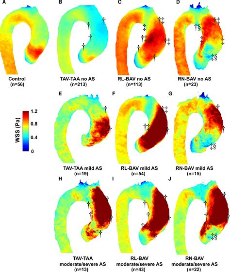 Aortic Valve Stenosis Alters Expression Of Regional Aortic Wall Shear