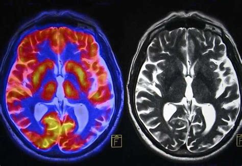 Mri Scans Of Human Brain Show Impact Of Alcohol And Tobacco