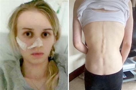 Anorexic Woman Who Thinks Air Has Calories Desperate For Treatment