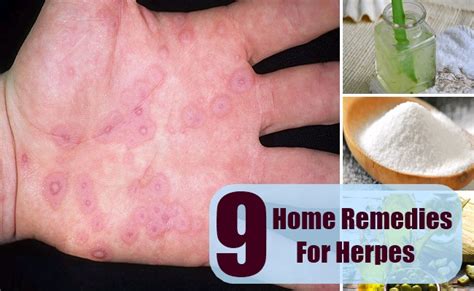 9 home remedies for herpes natural treatments and cure for