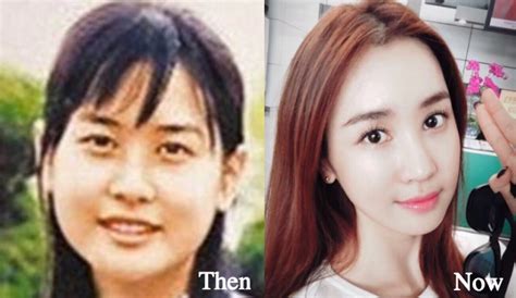 lee da hae plastic surgery before and after photos latest plastic