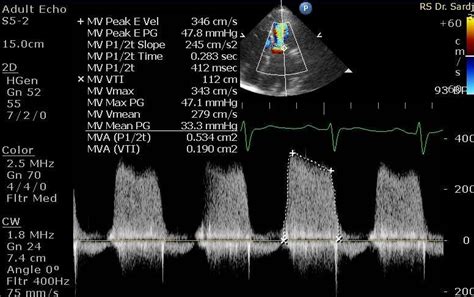 Transthoracic Echocardiography Showed Severe Mitral