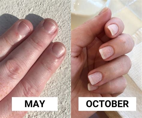 stop nail biting   years     finally broke