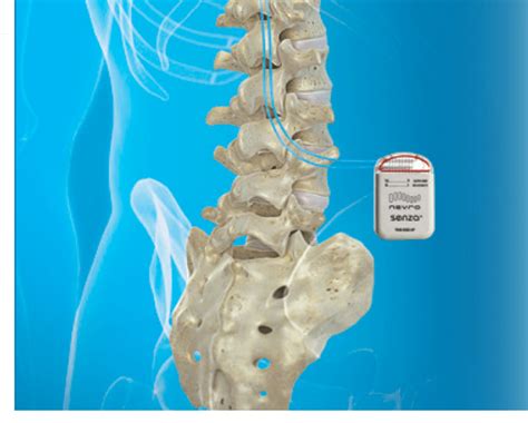 spinal cord stimulator  diabetic neuropathy  los angeles