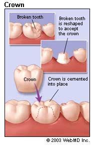 clean  temporary tooth crown intelligent dental