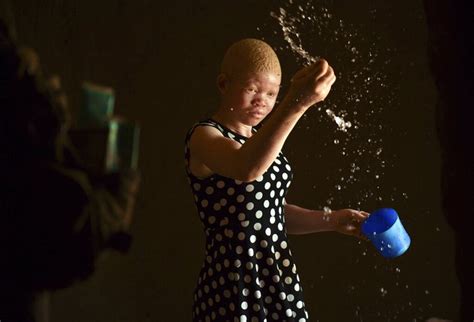 kehidupan anak albino  afrika   diliputi kecemasan foto
