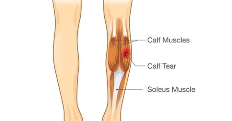 calf pain plantaris tendon rupture