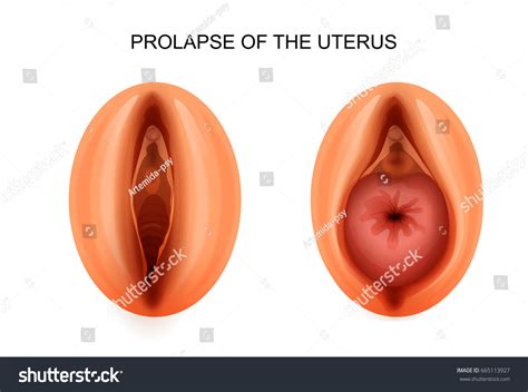 Vector Illustration Uterine Prolapse Gynecology Female