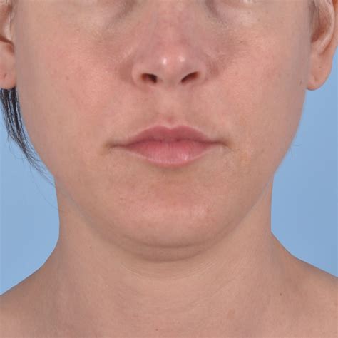 neck liposuction case  chevy chase md capital facial plastic
