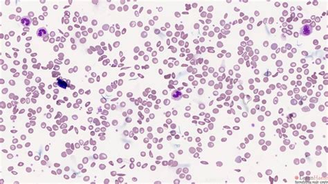 haemoglobin sc disease learnhaem haematology  simple