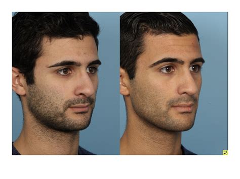 Before And After Gallery Male Rhinoplasty Dr Sidle Chicago
