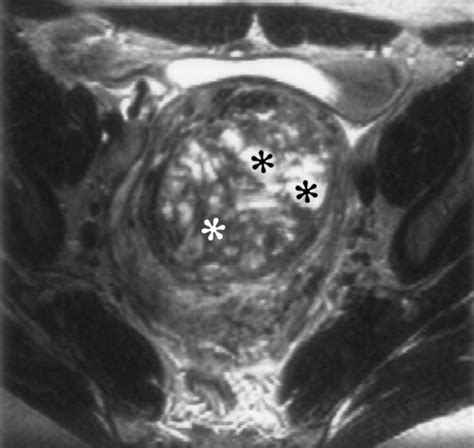 uterine leiomyomas histopathologic features mr imaging findings