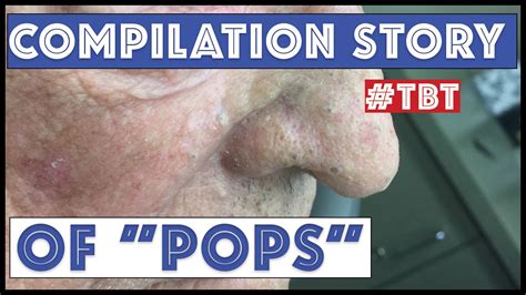 Pops And His Best Blackhead Extractions Tbt Youtube