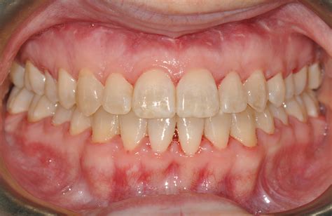 Jaw Surgery Before And After Smile Design
