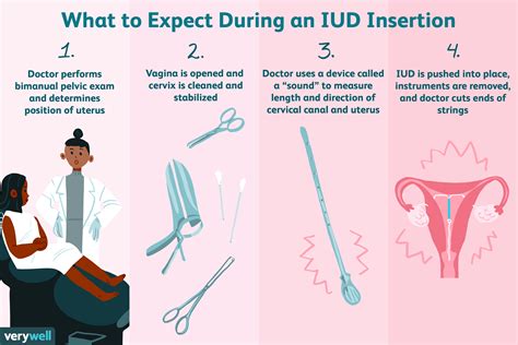 iud insertion what to expect procedure protection